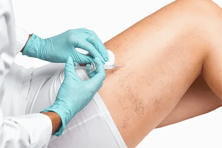 dr. alexandre zoppi escleroterapia