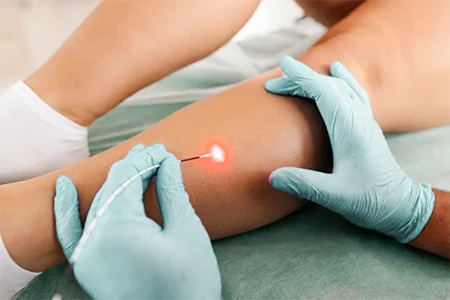 dr. alexandre zoppi laser safena