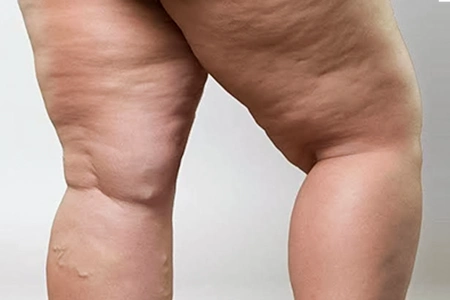 dr. alexandre zoppi lipedema